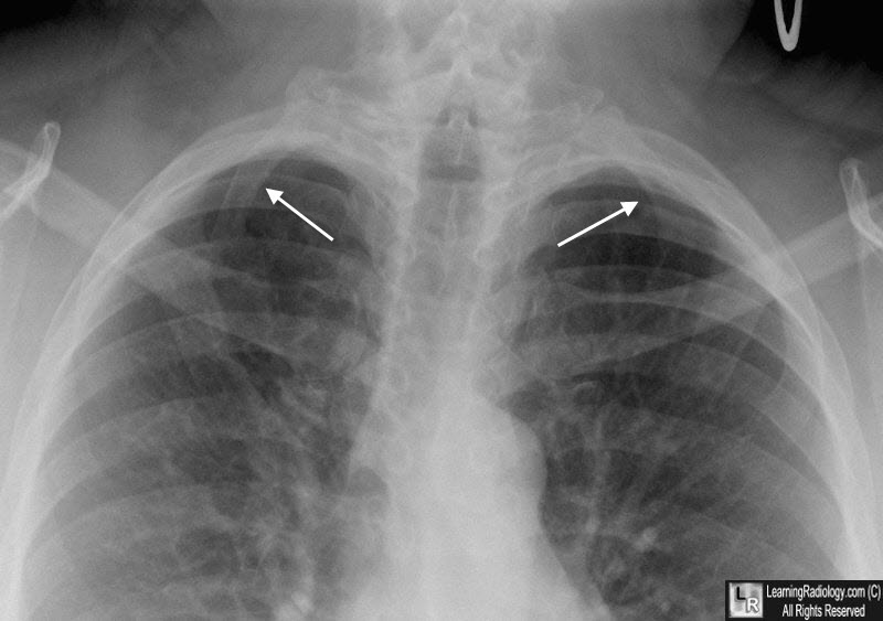 Bilateral cervical ribs